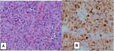 Management of Neuroendocrine Breast Carcinoma (NEBC): Review of Literature